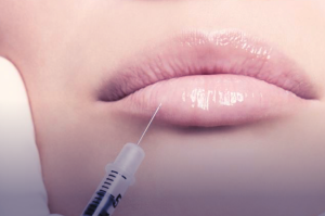 Close-up of a syringe injecting dermal filler into a person’s lips, demonstrating a cosmetic lip augmentation procedure.