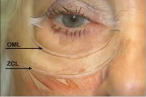 Anatomical illustration of the lower eyelid and cheek region, highlighting the orbital malar ligament (OML) and the zygomatic cutaneous ligament (ZCL) in relation to festoons and malar bags.