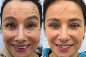 Before-and-after comparison of a woman’s face showing the effects of botulinum toxin treatment on forehead lines, crow’s feet, and under-eye wrinkles.