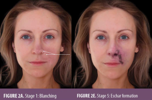 Side-by-side comparison of a woman’s face showing the progression of vascular occlusion from Stage 1 (blanching) to Stage 5 (eschar formation) following hyaluronic acid filler injection.
