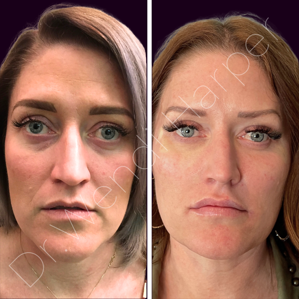 Before and after photo of full facial harmonization by Dr. Wendi Harper using advanced injectable techniques