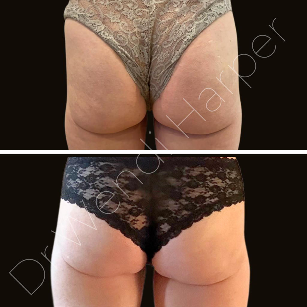 Before and after buttock contouring by Dr. Wendi Harper using fat dissolvers, hyaluronidase, hyaluronic acid, PLLA, and TCA peel