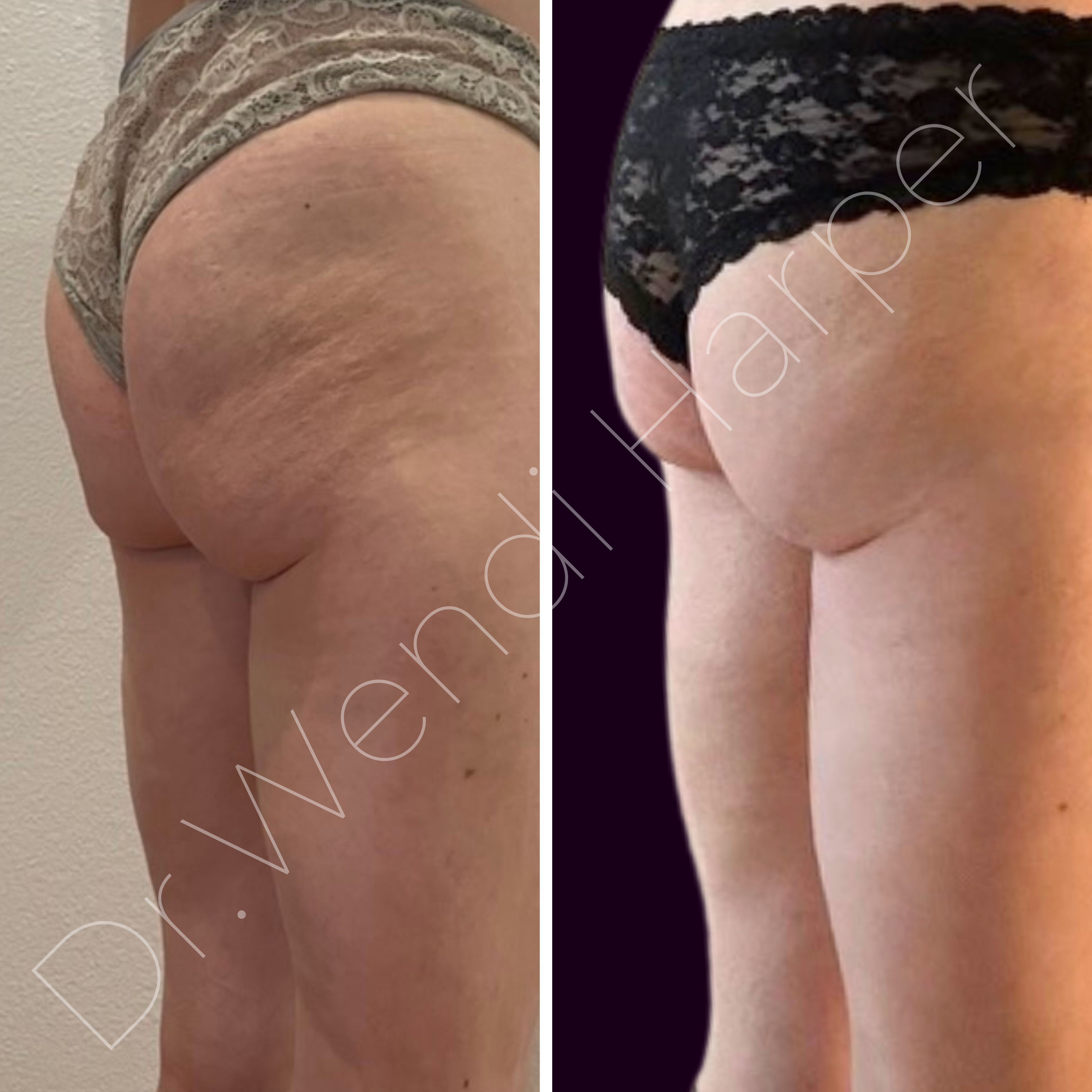 This advanced non-surgical body contouring case showcases Dr. Wendi Harper’s custom approach to buttock enhancement and hip dip smoothing. The lower gluteal region was treated with fat dissolvers and hyaluronidase to reduce bulk and address fibrosis, while the upper glutes and lateral hips were volumized with a hybrid blend of hyaluronic acid and PLLA (poly-L-lactic acid) for structure and lift. A final pass with a 20% TCA peel refined the skin surface and improved tone and texture. The result: a lifted, sculpted, and smoother silhouette without implants, fat grafts, or downtime. This case exemplifies the kind of protocol mastery offered in Heddy’s elite-level trainings—perfect for reps driving advanced product education, injectors ready to break into body work, and PE-backed practices seeking differentiated offerings with high ROI.