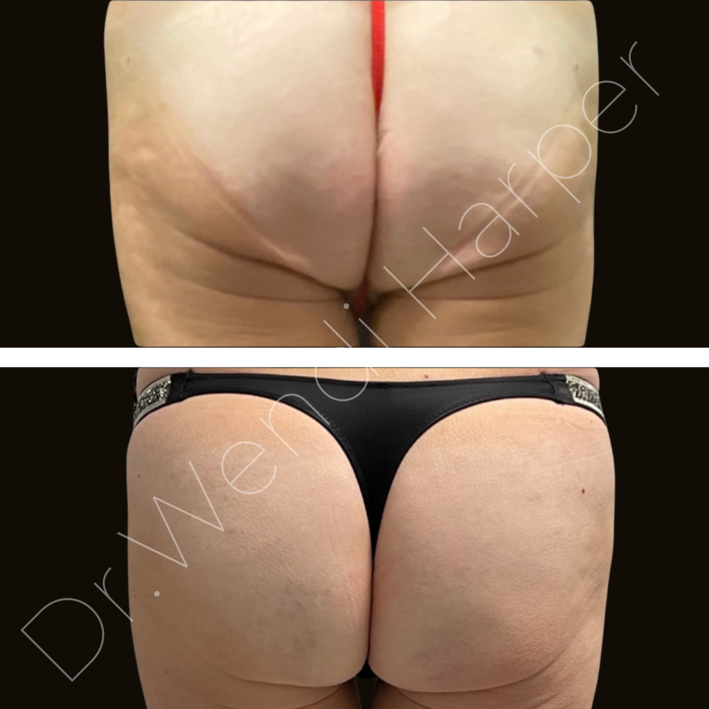 Before and after Bellafill butt augmentation by Dr. Wendi Harper using 100 syringes over 3 treatments for non-surgical, permanent volume