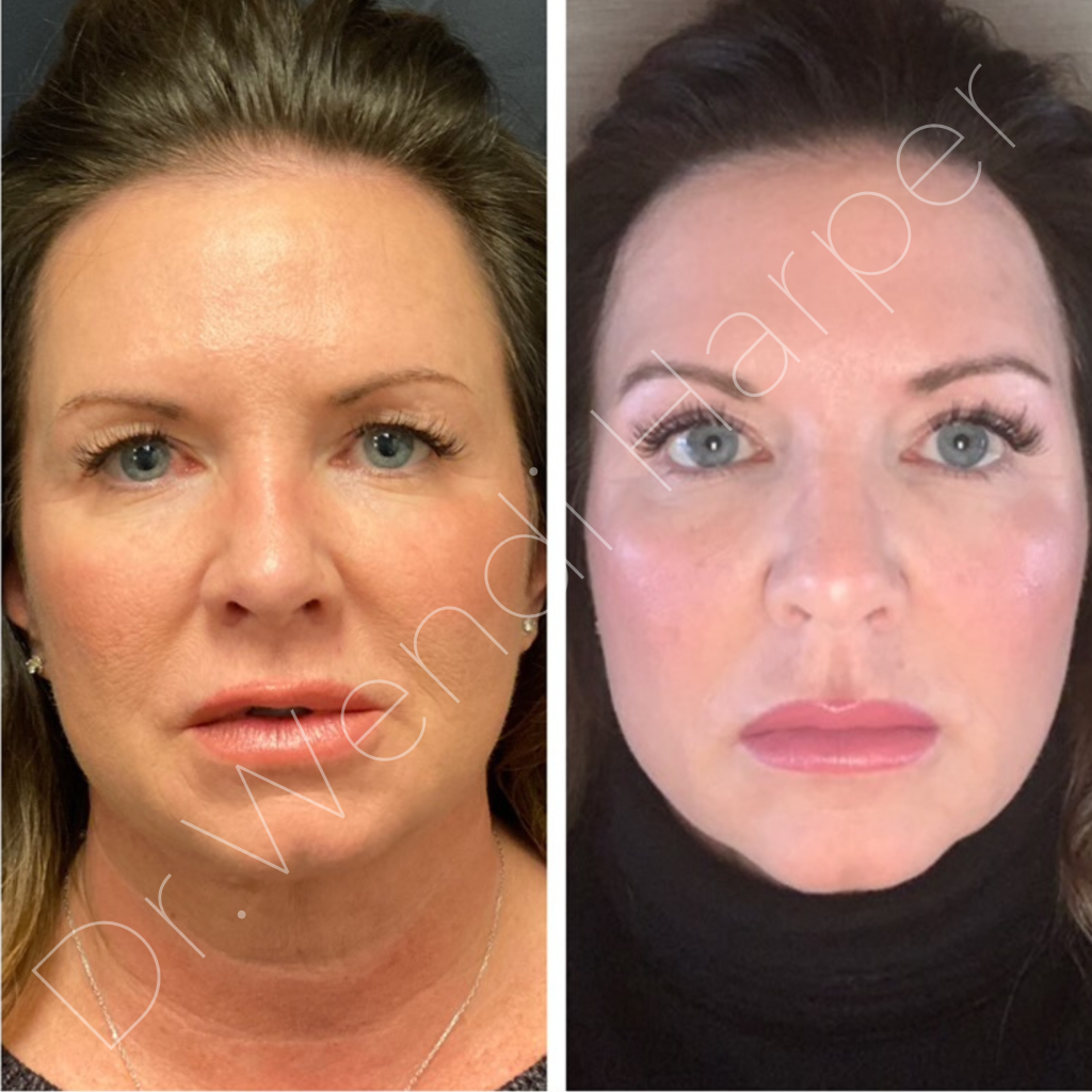 Before and after full facial Bellafill treatment by Dr. Wendi Harper on Bellafill sales representative using 12 syringes in one session