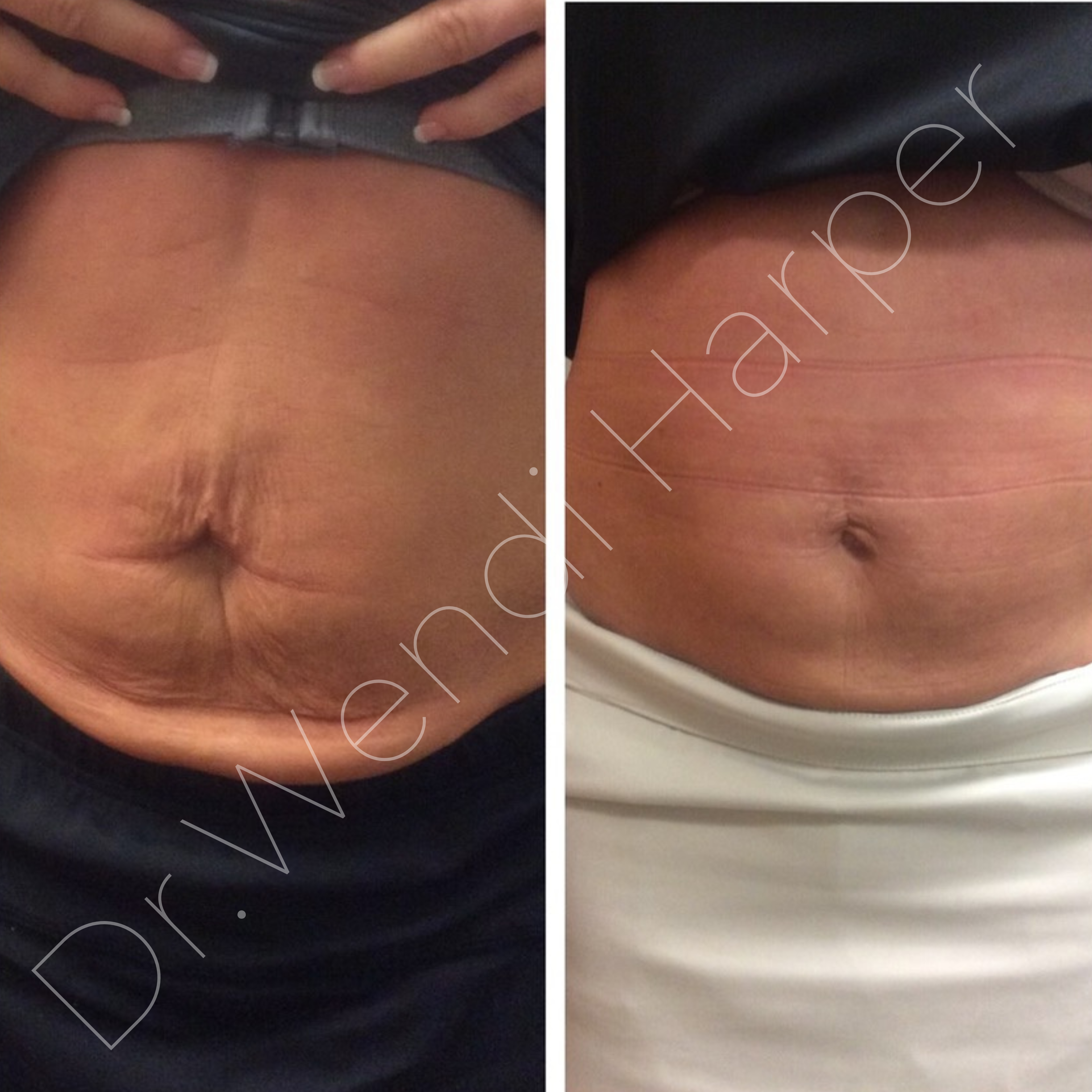Before and after non-surgical abdominal skin tightening and contouring using fat dissolver and hyperdiluted Bellafill by Dr. Wendi Harper