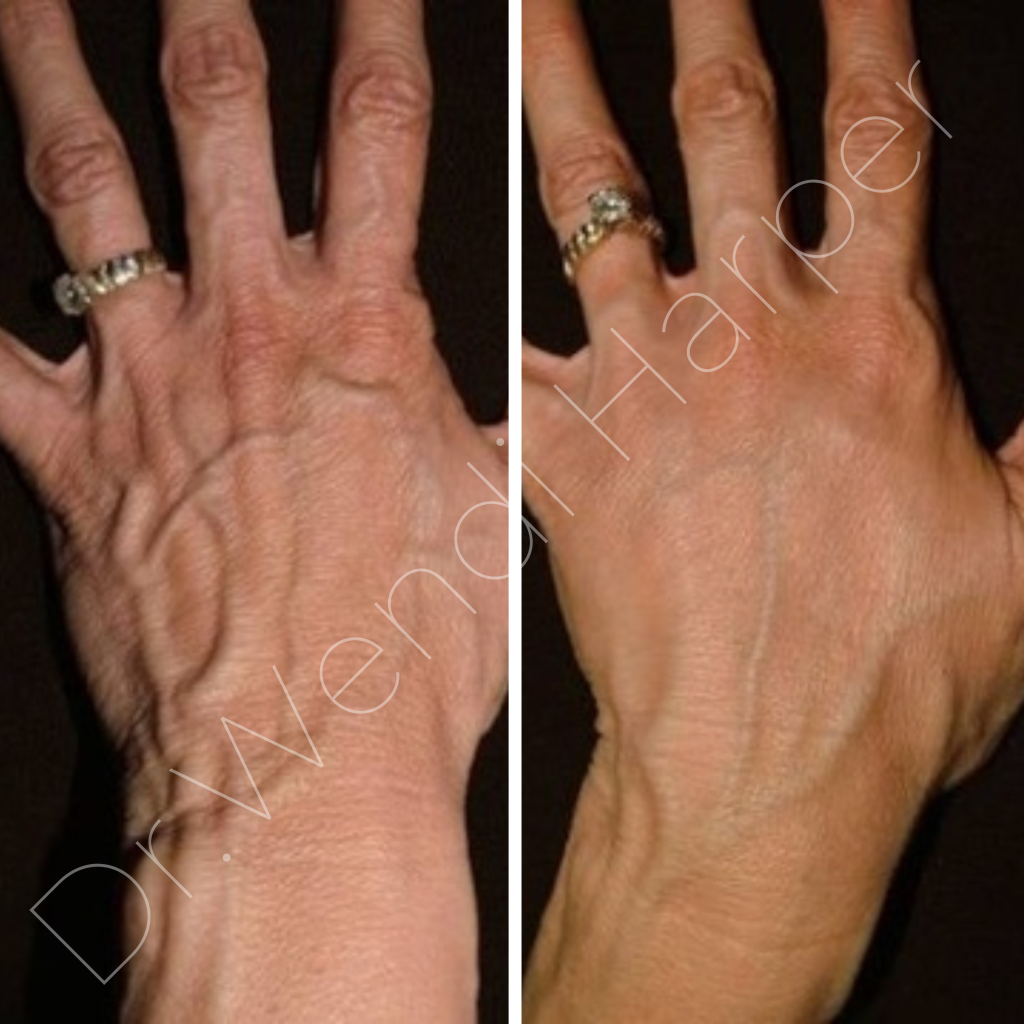 Before and after Bellafill hand rejuvenation by Dr. Wendi Harper using 5 syringes diluted 1:1 over two sessions