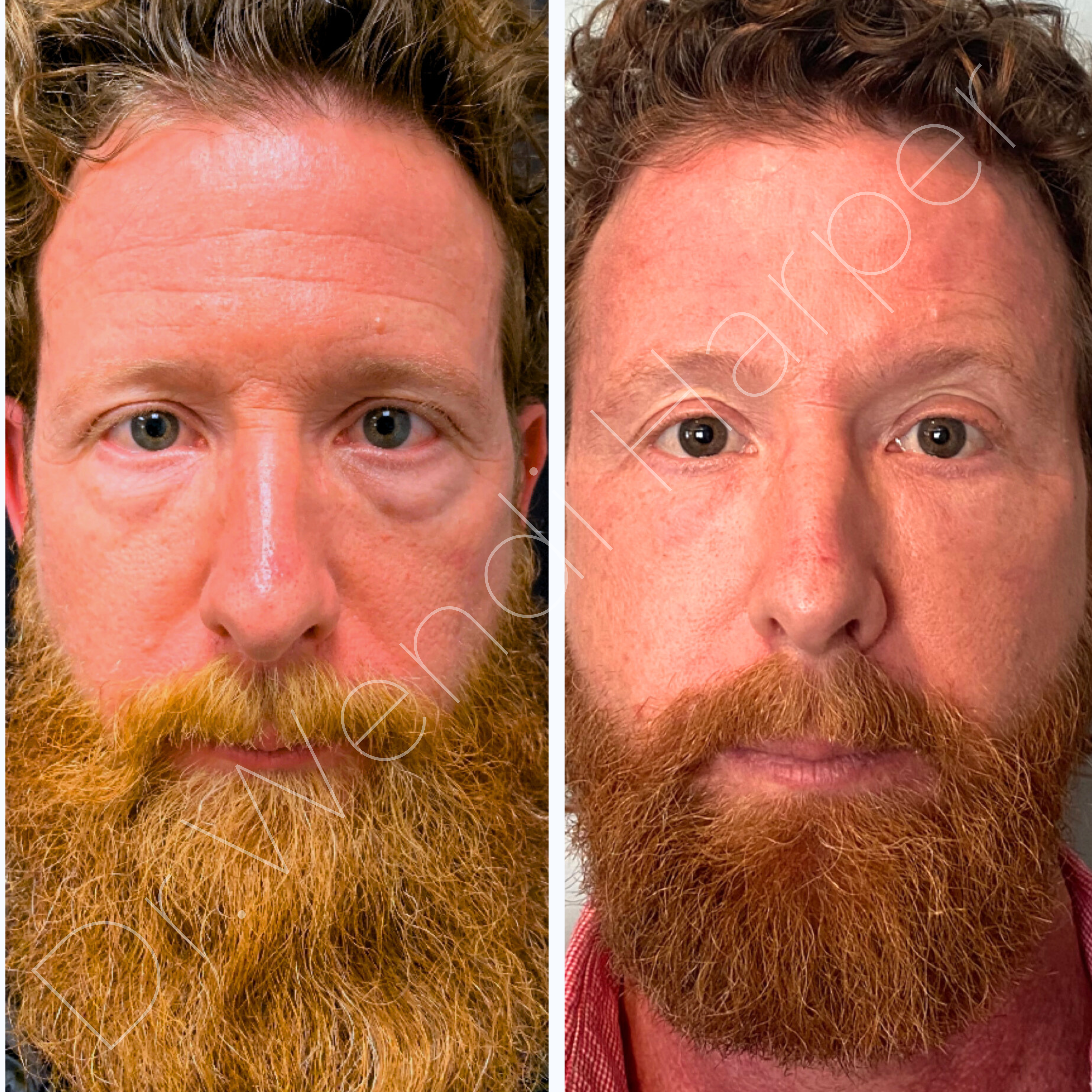 Before and after male facial balancing with dermal fillers, including under-eyes, temples, jawline, and mid-face enhancements.