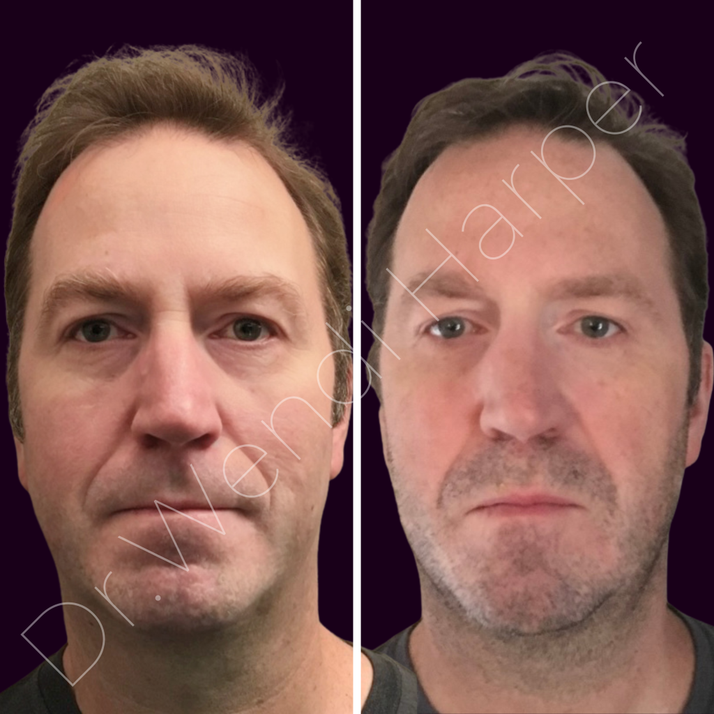 This before-and-after image showcases a high-impact non-surgical rhinoplasty performed by Dr. Wendi Harper. The result: lifted nasal tip, smoothed dorsal hump, and refined side profile—all achieved using advanced filler placement techniques without surgery. A top-tier example of how injectable artistry can transform facial proportions with precision and safety. Ideal training reference for reps aiming to boost advanced filler use, for injectors looking to elevate their skill beyond cheeks and lips, and for med spa operators and private equity groups seeking in-house training that delivers visible, high-value outcomes.