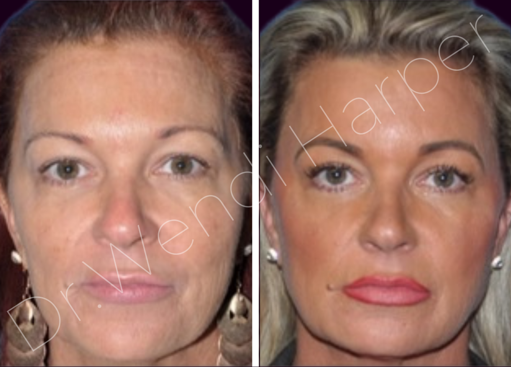 Before and after full facial injectable transformation with 12 syringes of Bellafill by Dr. Wendi Harper on med spa manager at top plastic surgery practice