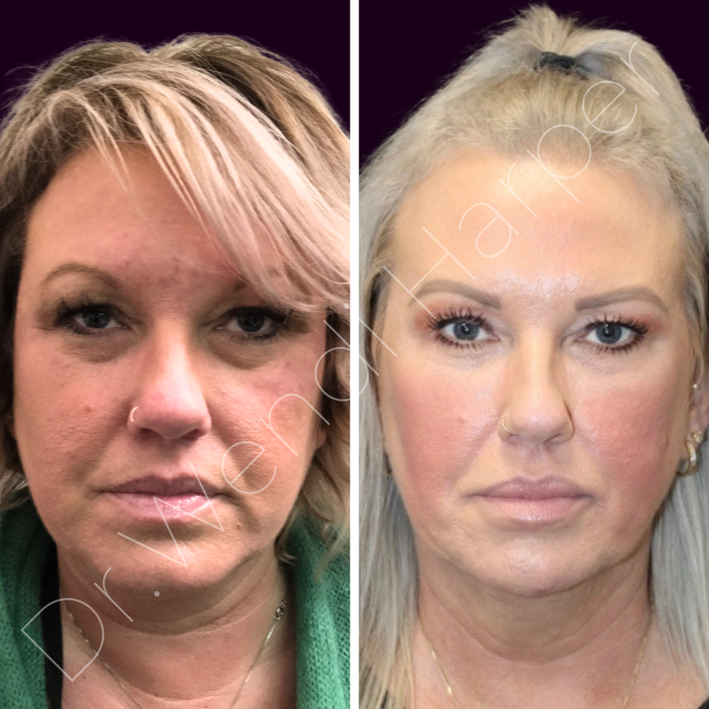 Before and after full facial rejuvenation by Dr. Wendi Harper with advanced injectables for volume loss, skin texture, and facial contouring