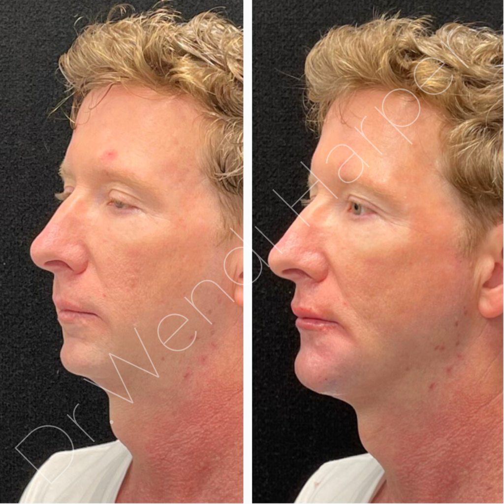 Before and after photos of male patient following full facial balancing performed by Dr. Wendi Harper, showcasing improved jawline definition, midface volume, and overall symmetry.