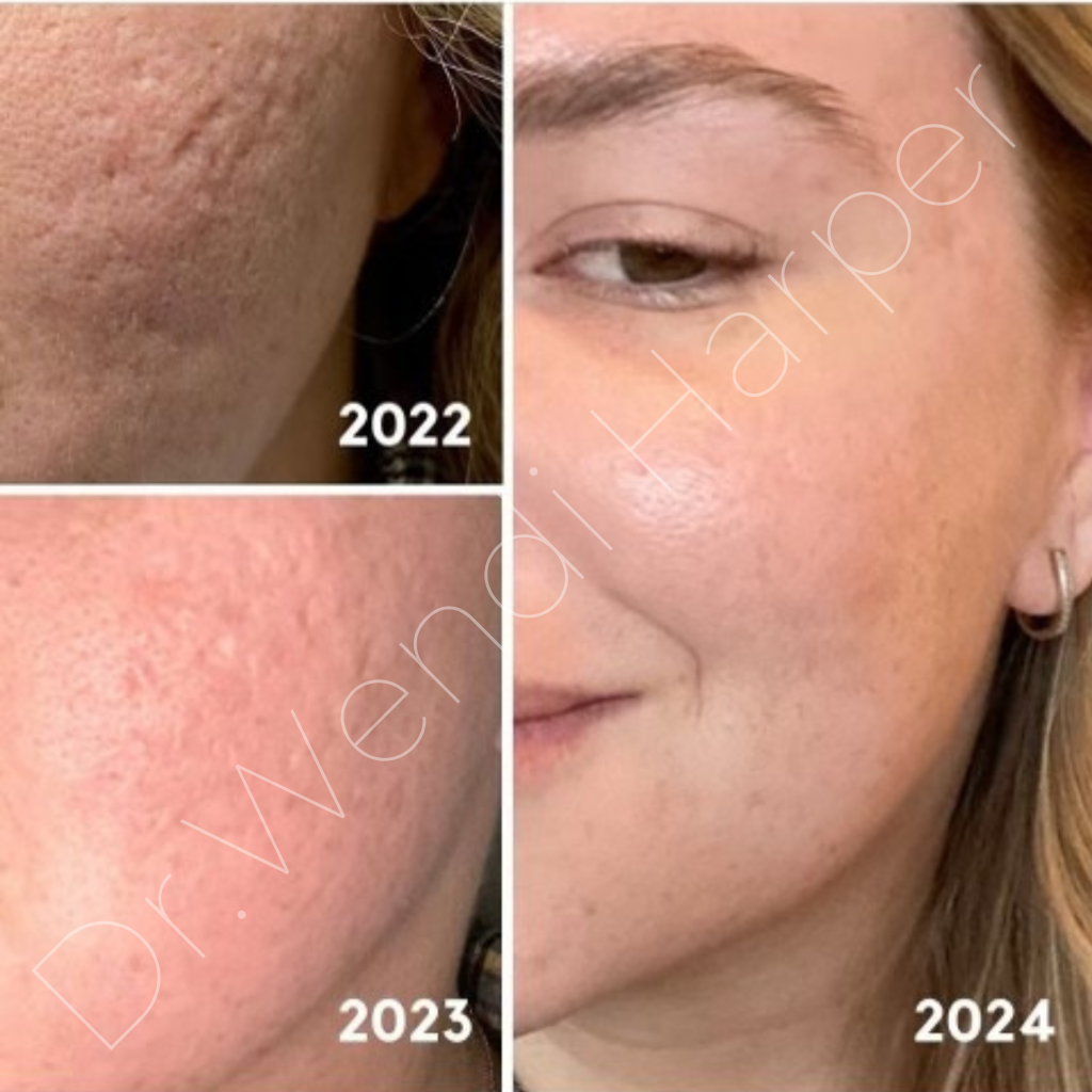 Three-year acne scar transformation using Bellafill and Collagenaise by Dr. Wendi Harper (2022–2024 progression)