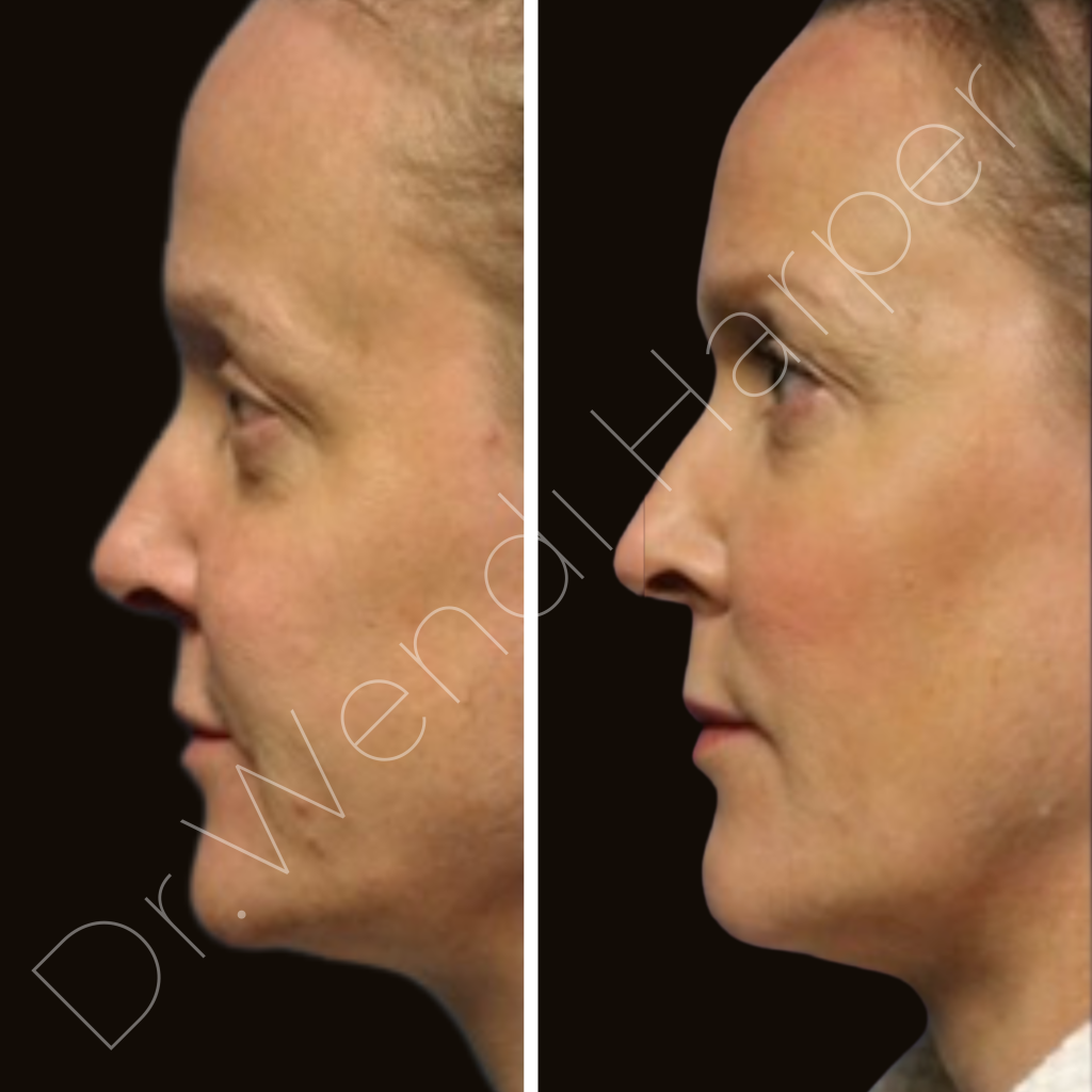 Side profile before and after full facial harmonization by Dr. Wendi Harper on practice manager of top U.S. plastic surgeon