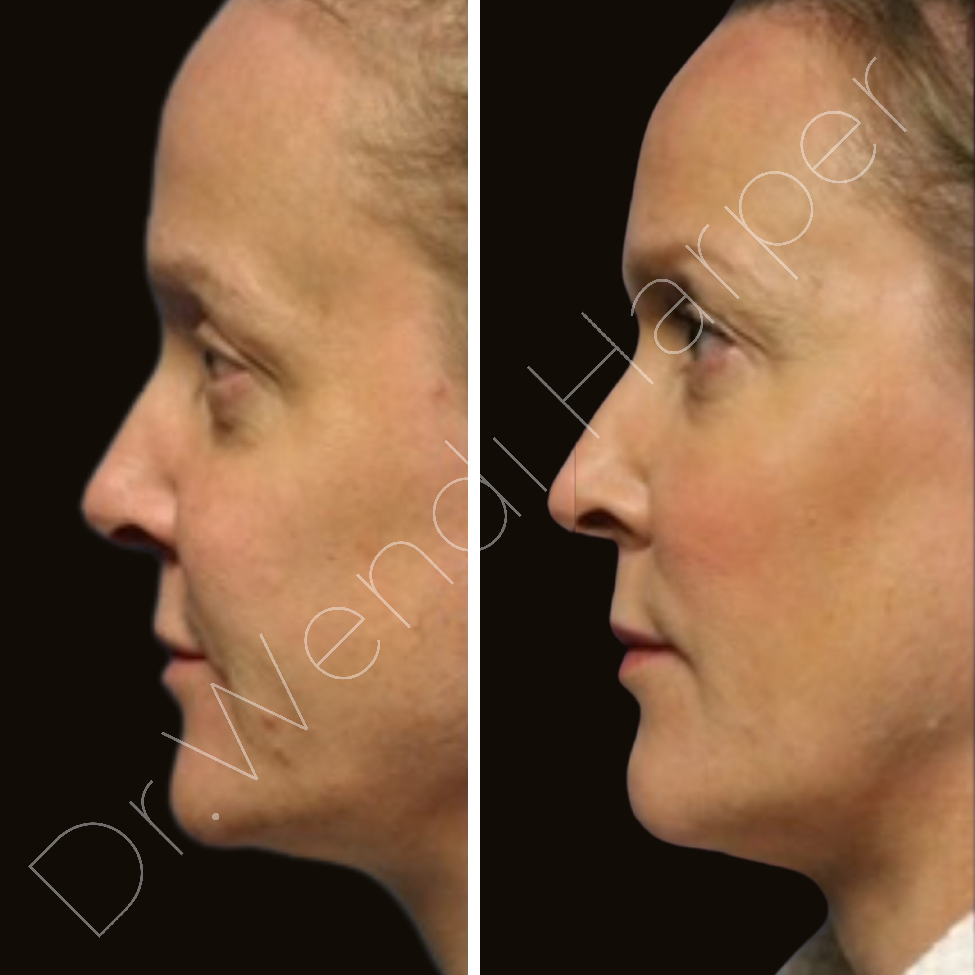 Side profile before and after full facial harmonization by Dr. Wendi Harper on practice manager of top U.S. plastic surgeon
