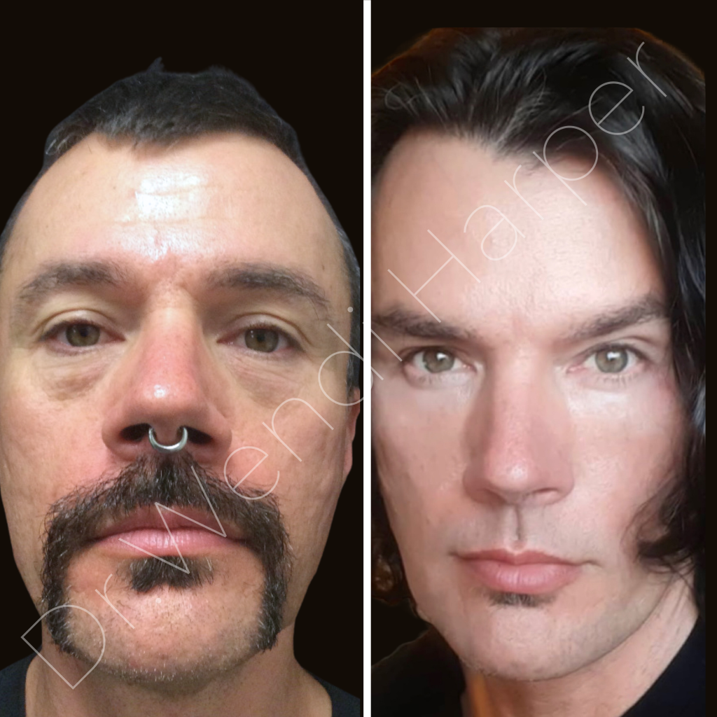 Before-and-after results of a patient treated by Dr. Wendi Harper Lonabough using sequential facial filling techniques
