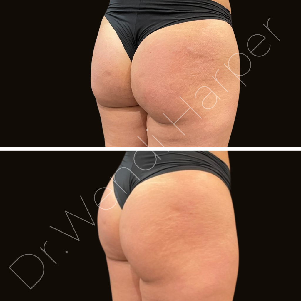 Before-and-after transformation of a patient treated with hyperdilution techniques for gluteal enhancement by Dr. Wendi Harper Lonabough.