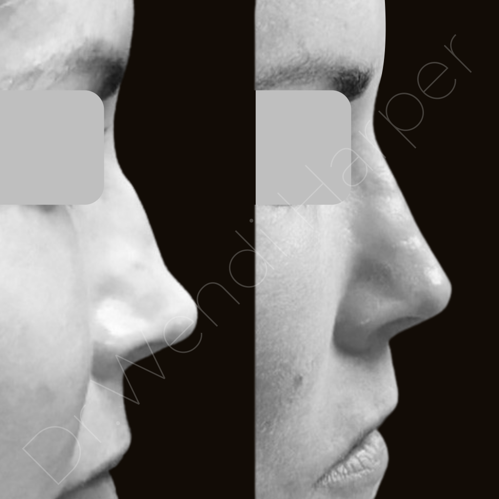 Before and after non-surgical rhinoplasty with injectable nose reshaping by Dr. Wendi Harper