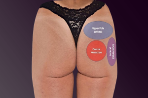 Image of a patient’s buttocks with labeled treatment zones for upper pole lifting, central projection, and lateral expansion in non-surgical buttock augmentation