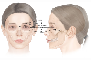 Medical illustration showing the skeletal anatomy of a female face in frontal and lateral views, highlighting crucial zygomatic and orbital landmarks used in aesthetic medicine.