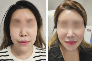 Side-by-side photos showing a female patient before and six weeks after triamcinolone injection to treat fibrotic tissue caused by hyaluronic acid filler in the nasolabial folds.