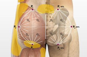 Anatomical gluteal mapping diagram for PLLA injections in male patients showing quadrant-based collagen stimulator distribution using the C-Tech method