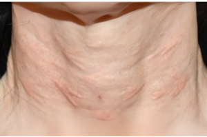 Close-up of the anterior neck showing multiple visible linear nodules after hyperdiluted calcium hydroxylapatite (CaHA) treatment.