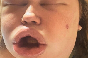 Close-up of a person’s face showing extreme swelling of the lips and cheeks, with a slightly parted mouth and visible nasal piercing—potentially indicating an adverse reaction to hyaluronic acid filler or hyaluronidase.