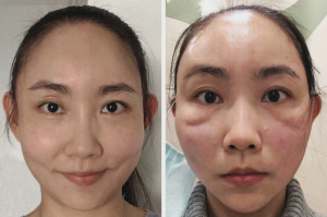Side-by-side comparison showing a woman before and six days after a PDO thread lift. The post-procedure image reveals pronounced indentations in both cheeks, characteristic of thread-related dimpling.