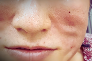 Adverse Event: Dimpling Following Thread Lift - Clinical Case Study on Post-Procedure Complications in Aesthetic Medicine