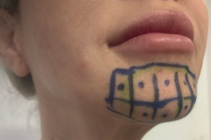 Chin marked with injection grid technique for botulinum toxin A treatment, part of a novel approach from Italian clinicians targeting dynamic dimpling and peau d’orange texture.