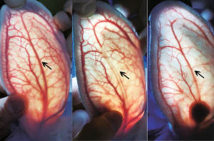 Transillumination images of rabbit ears comparing vascular occlusion after intra-arterial injection of PMMA vs. hyaluronic acid (HA), demonstrating significantly greater embolism risk and tissue necrosis with HA.