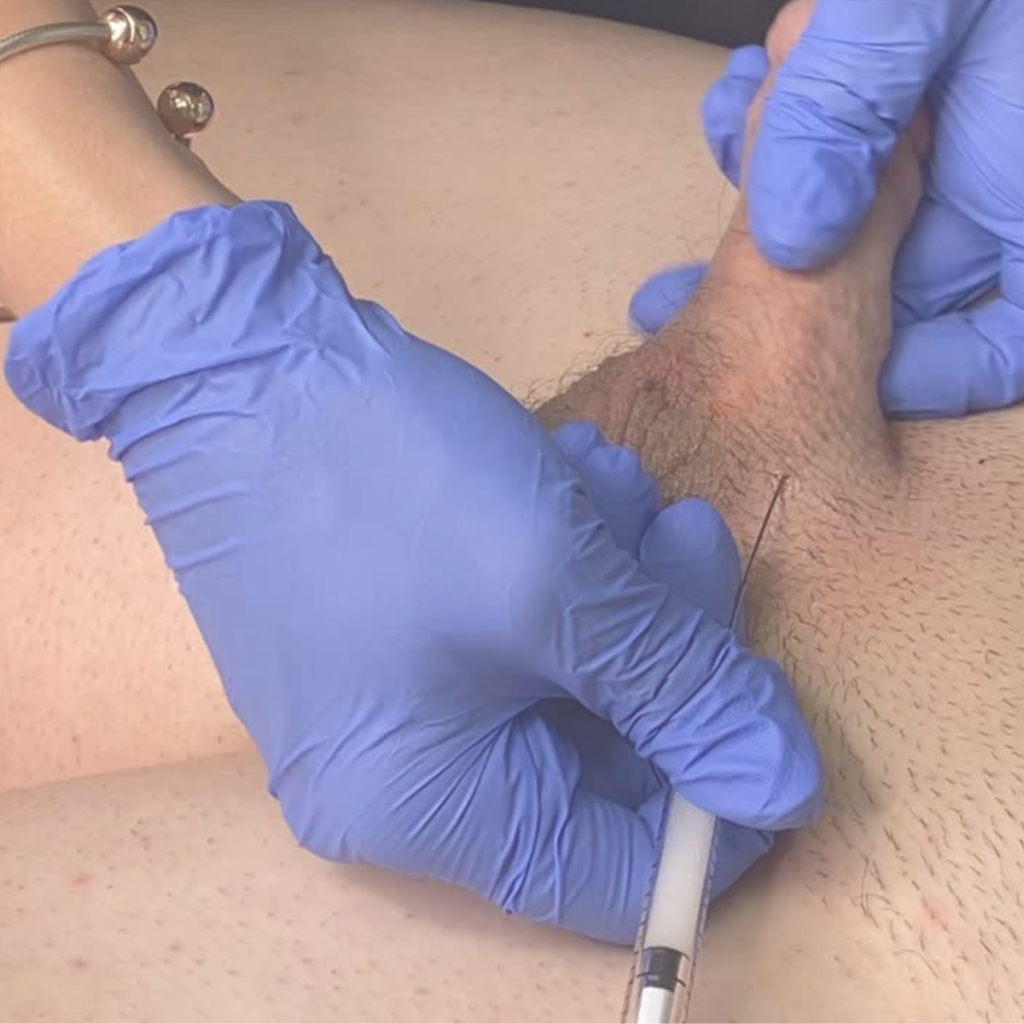Close-up of practitioner injecting penile shaft during hands-on filler training session