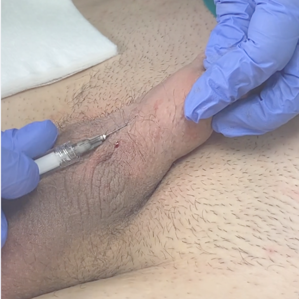 Close-up of penile filler injection during hands-on male enhancement training session