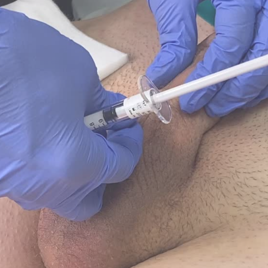 Syringe delivering filler to penile shaft during live training session
