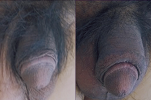 Comparison of Penile Appearance Before and After Dermal Filler Augmentation - Study on Optimal Filler Choice for Male Genital Enhancement
