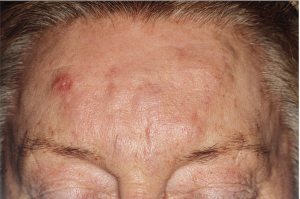 Foreign Body Granulomas From Polymethylmethacrylate Treated Successfully with Allopurinol