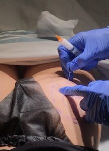 Gluteal collagen stimulating filler injection demonstrated during a clinical gluteal lift and enhancement training organized by Dierdre Slavin.