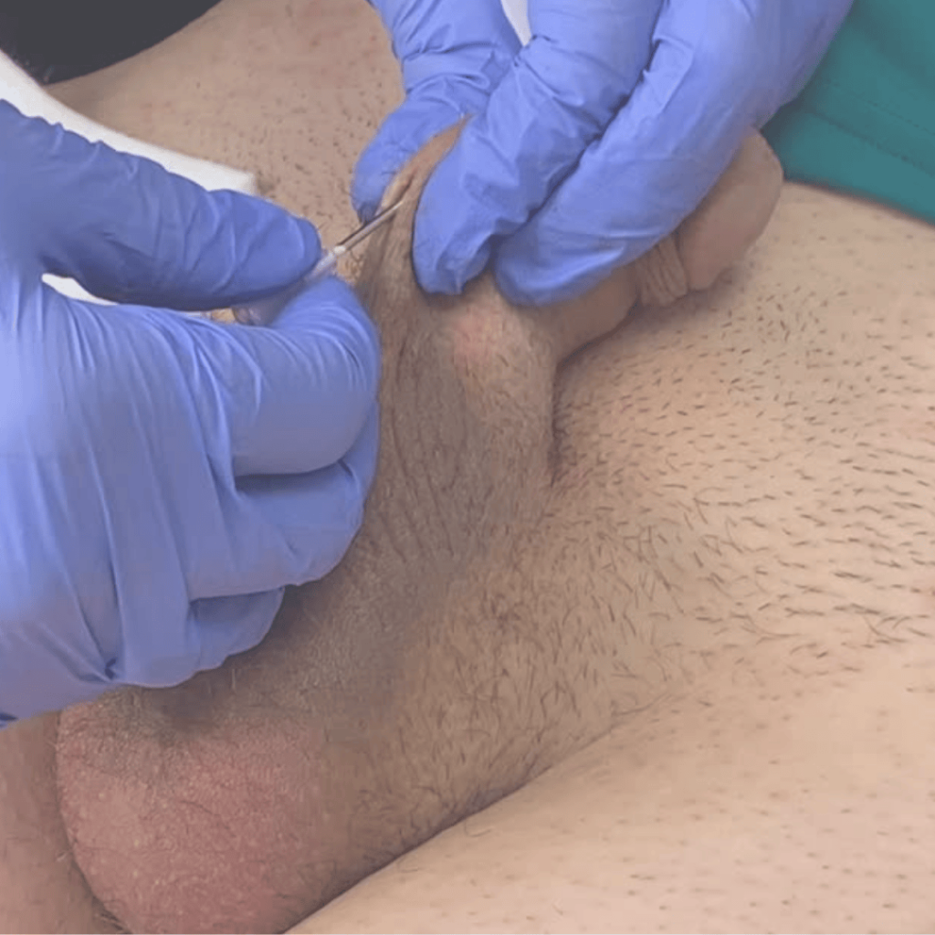 Close-up of Dr. Wendi Harper performing penile filler injection with a cannula during Heddy Tech’s male enhancement training.