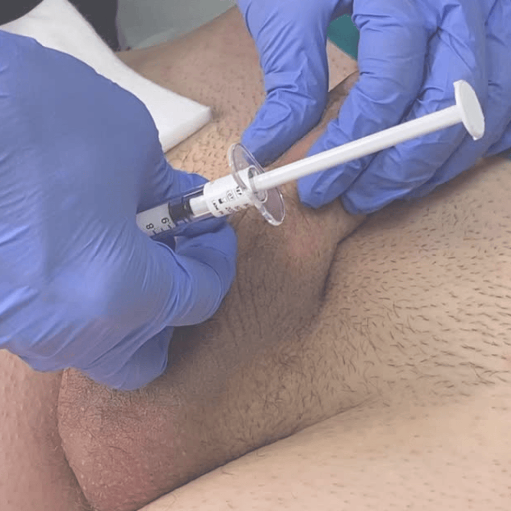 This image shows a practitioner using a cannula to administer dermal filler along the penile shaft during Heddy’s advanced, in-practice male girth injectable training. The session emphasizes safe entry points, proper depth, product distribution, and technique refinements for optimal aesthetic and functional outcomes in penile augmentation.