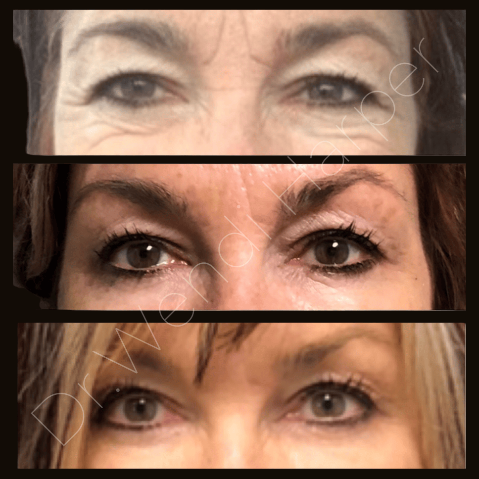 Three-part transformation of a female patient’s eye area over several years, showing progressive improvement in wrinkles, hollowness, and skin texture using injectables and skin resurfacing.