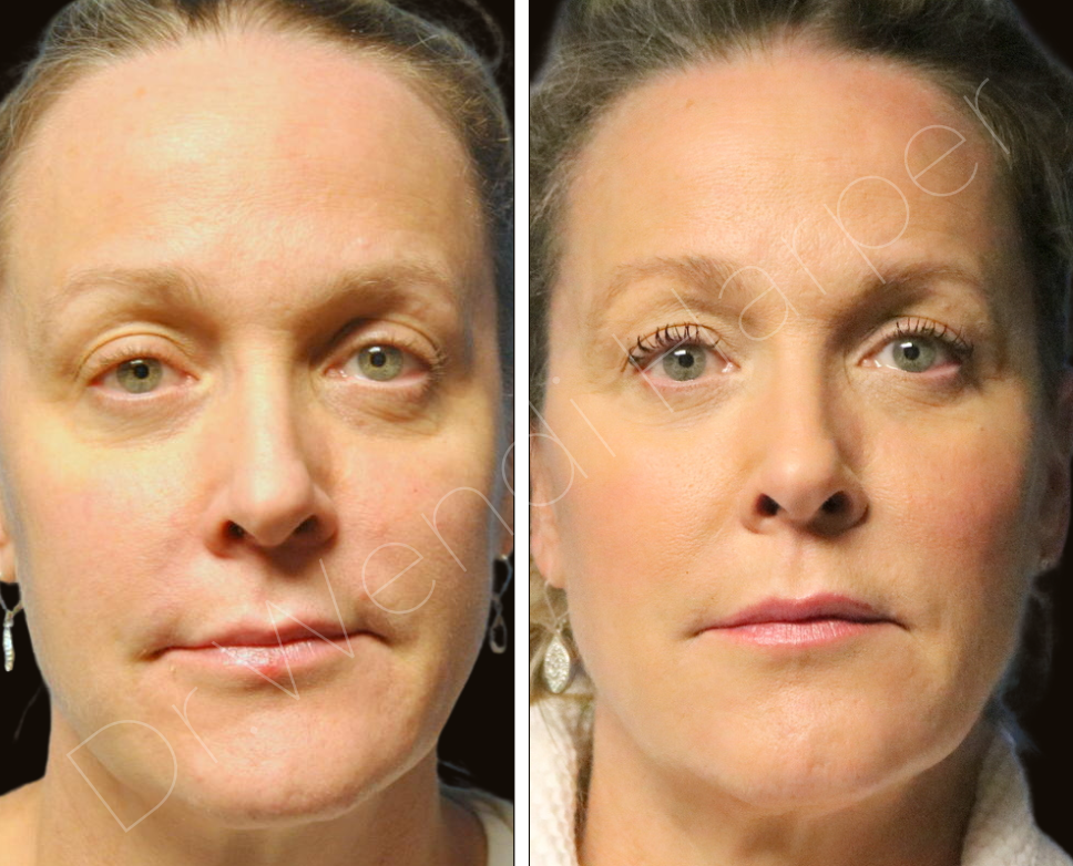 Side profile before and after full facial harmonization by Dr. Wendi Harper on practice manager of top U.S. plastic surgeon