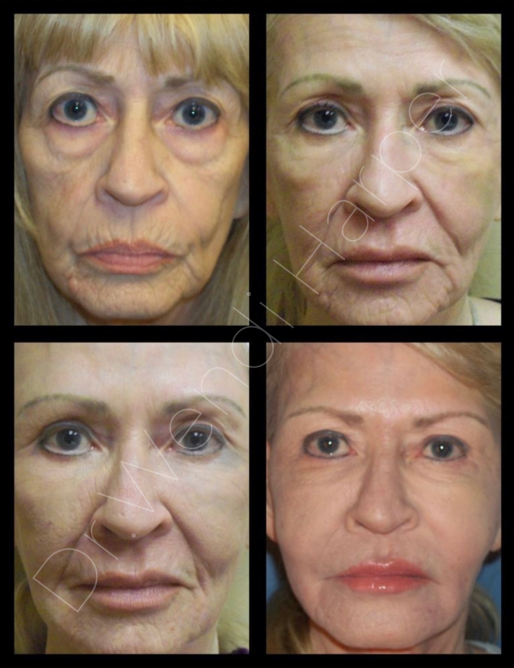 Before-and-after progression of a mature female patient across multiple facial rejuvenation sessions using advanced injectable techniques by Dr. Wendi Harper. Results show volume restoration, periorbital softening, lip enhancement, and overall facial revitalization.