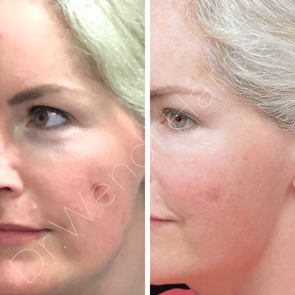 b-a-steroid atrophy filled-pigment treated (1)