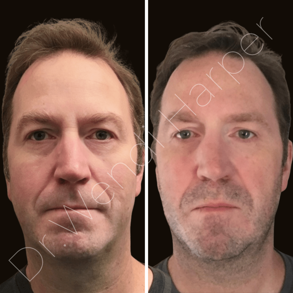 Before-and-after photo of a middle-aged male patient treated with 4 vials of Sculptra for full-face rejuvenation, showing natural volume restoration and improved skin quality. Injected by Dr. Wendi Harper.