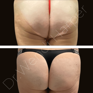 Before and after image showing gluteal augmentation with 10 kits of Bellafill per cheek, performed using Heddy’s protocol.