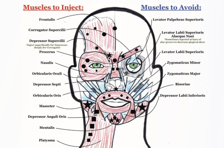 “Facial muscle injection map showing muscles to inject and avoid in botulinum toxin procedures, adapted from Julie Bass Kaplan’s 2017 Plastic Surgical Nursing article Consideration of Muscle Depth for Botulinum Toxin Injections: A Three-Dimensional Approach.”