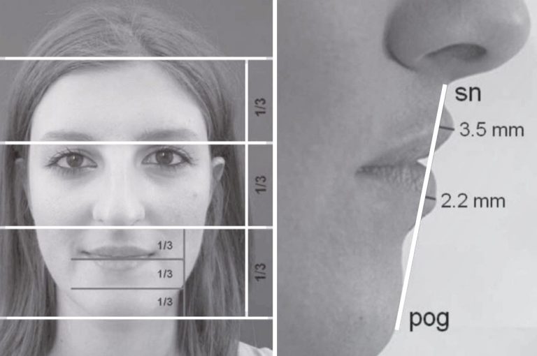 Frontal and lateral facial analysis showing horizontal facial thirds and the golden-ratio projection of the upper and lower lips, illustrating ideal lip proportions in facial aesthetics.