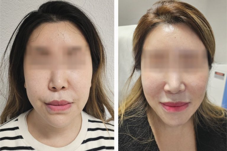 Before and after photos of a female patient with hyaluronic acid-induced fibrotic bulges along the nasolabial fold, treated with intralesional triamcinolone. Image from: Peros I, Haneke E. “Fibrotic Reaction to Hyaluronic Acid Fillers in the Face,” J Cosmet Dermatol, 2024.