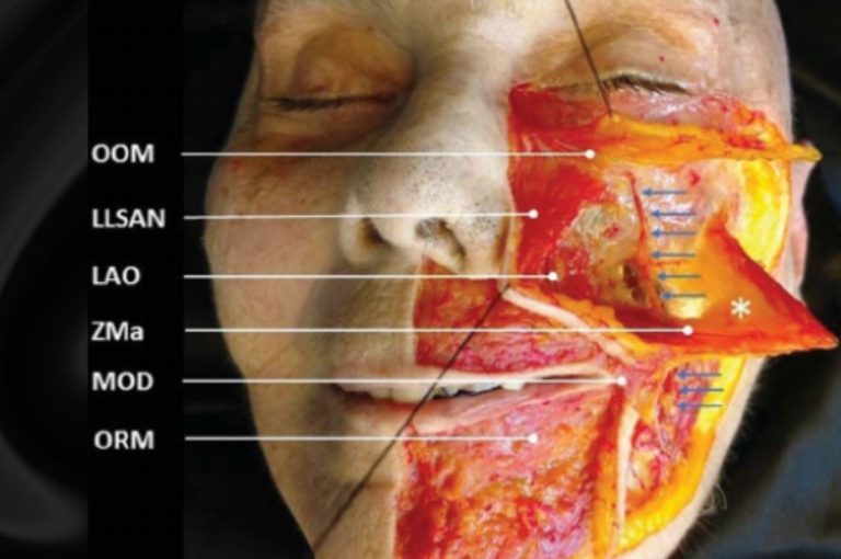 Cadaveric dissection of the face highlighting key anatomical structures, including the orbicularis oris muscle (OOM), levator labii superioris alaeque nasi (LLSAN), and the transverse facial septum, relevant to facial overfilled syndrome.